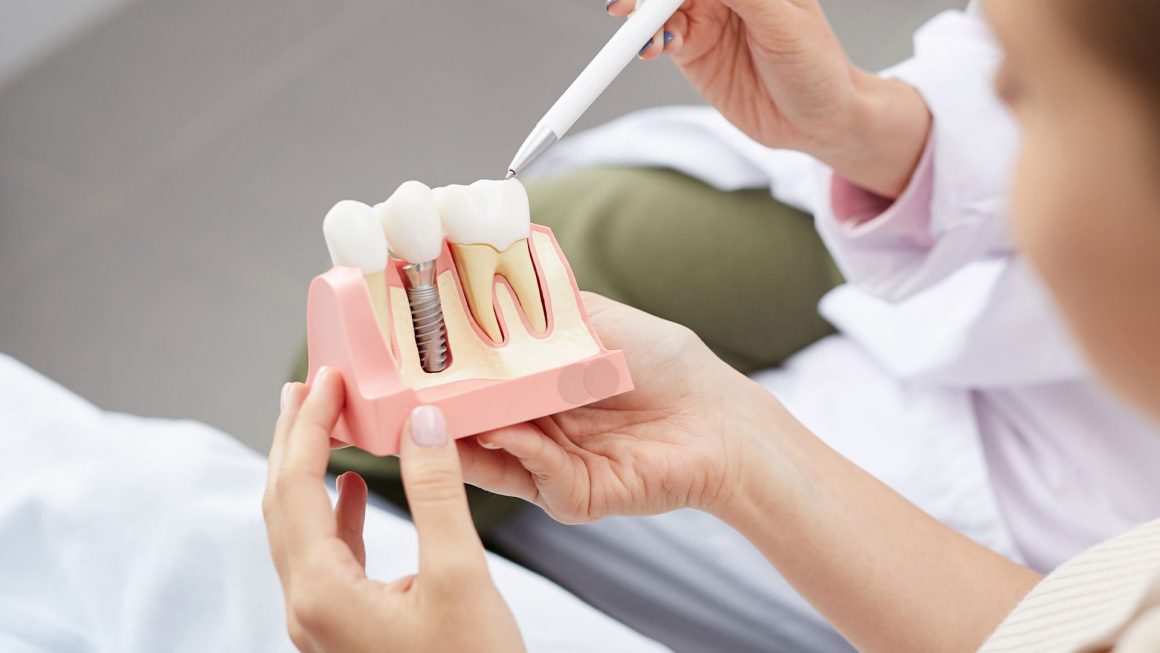 PROTESIS_DENTAL_IMA01 Prótesis dental
