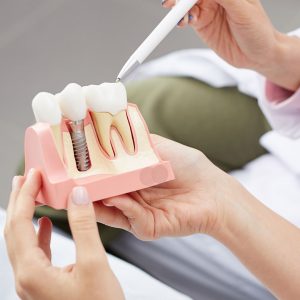 PROTESIS_DENTAL_IMA01 Prótesis dental